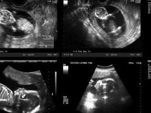 解读郑州三代试管婴儿费用，这些收费项目需要提前了解！